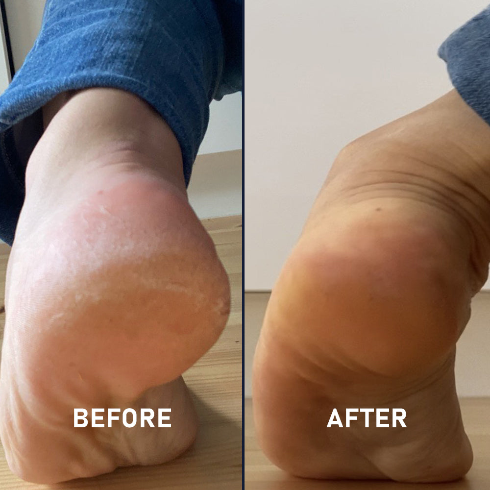 Heelalujah Kit Best Cracked Heels Treatment Australia