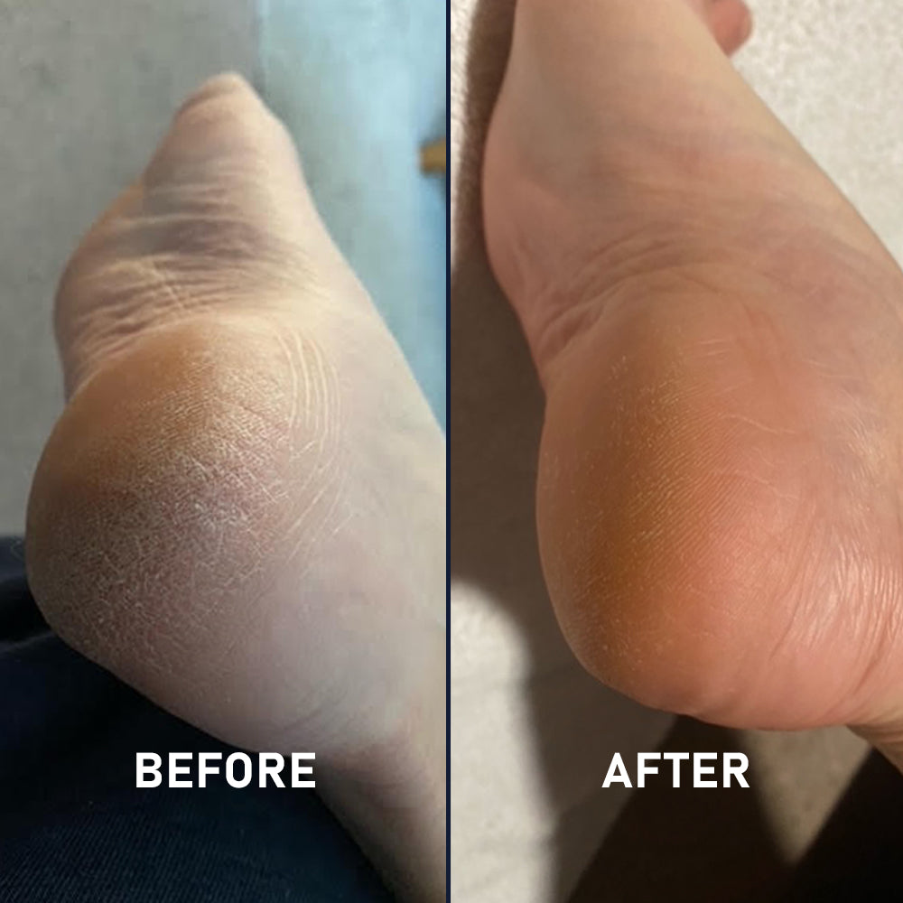 Silicone Sockette Kit