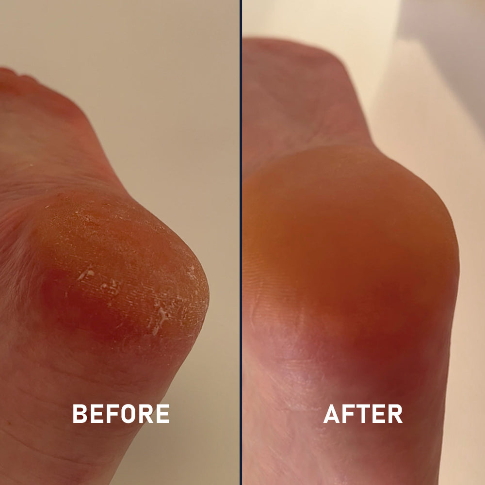 Silicone Sockette Kit