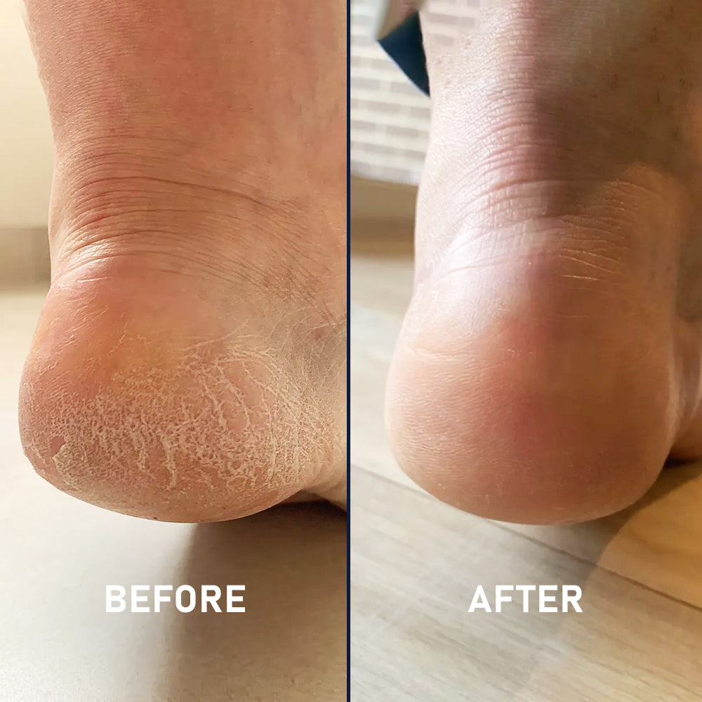 Silicone Sockette Kit