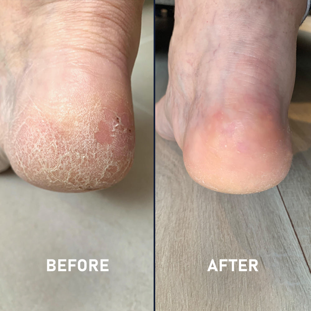 Heelalujah Kit Pack Cracked Heels Treatment - Main Image