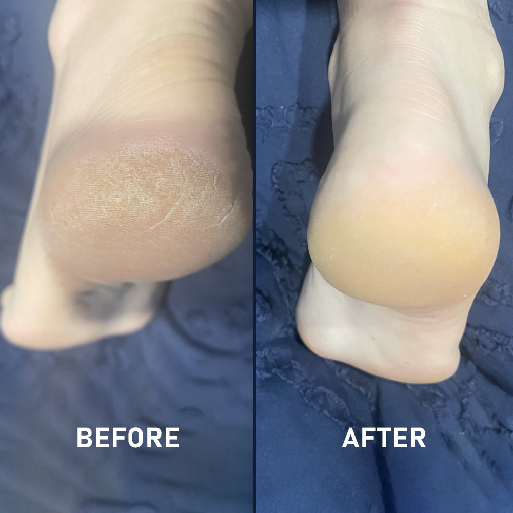 Silicone Sockette Kit