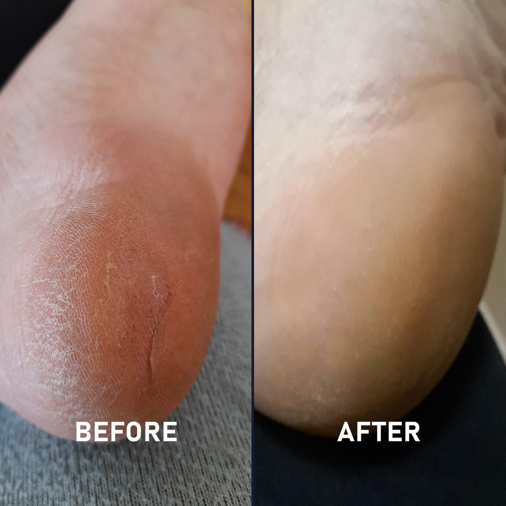 Silicone Sockette Kit - 2 Pack