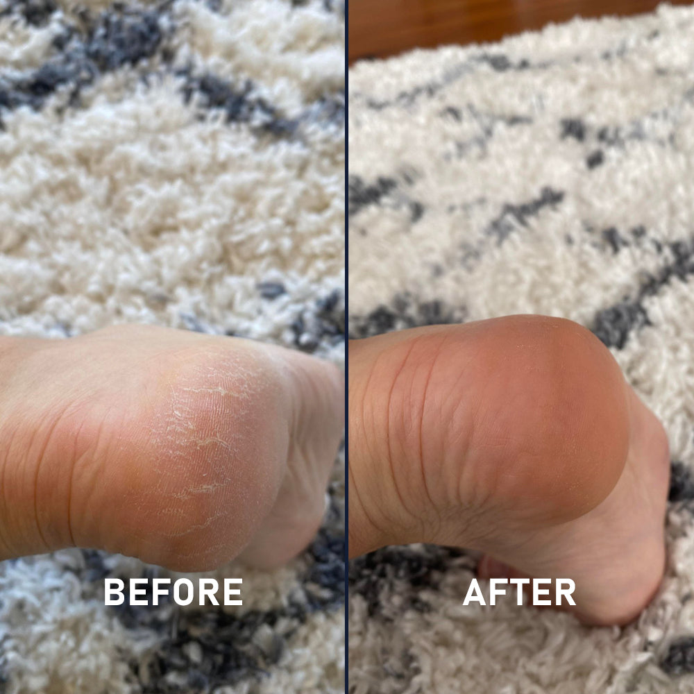 Silicone Sockette Kit