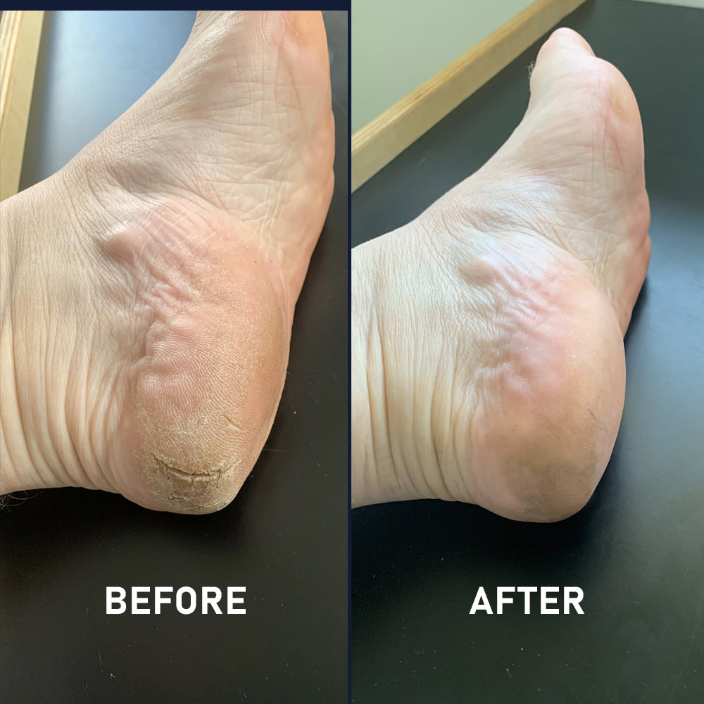 Heel Balm 50mL - 4 Pack