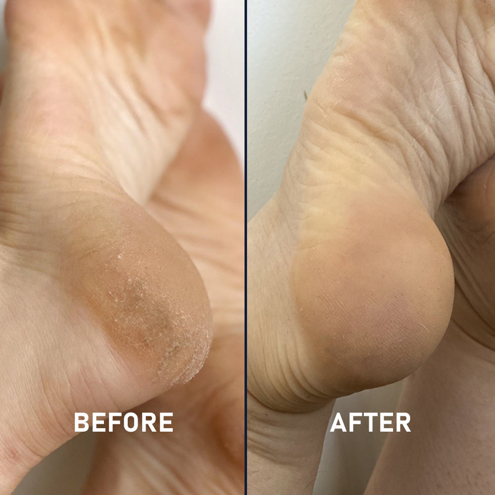 Silicone Sockette Kit - 2 Pack